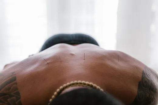 Dry Needling for Low Back Pain: How It Releases Stubborn Muscle Knots