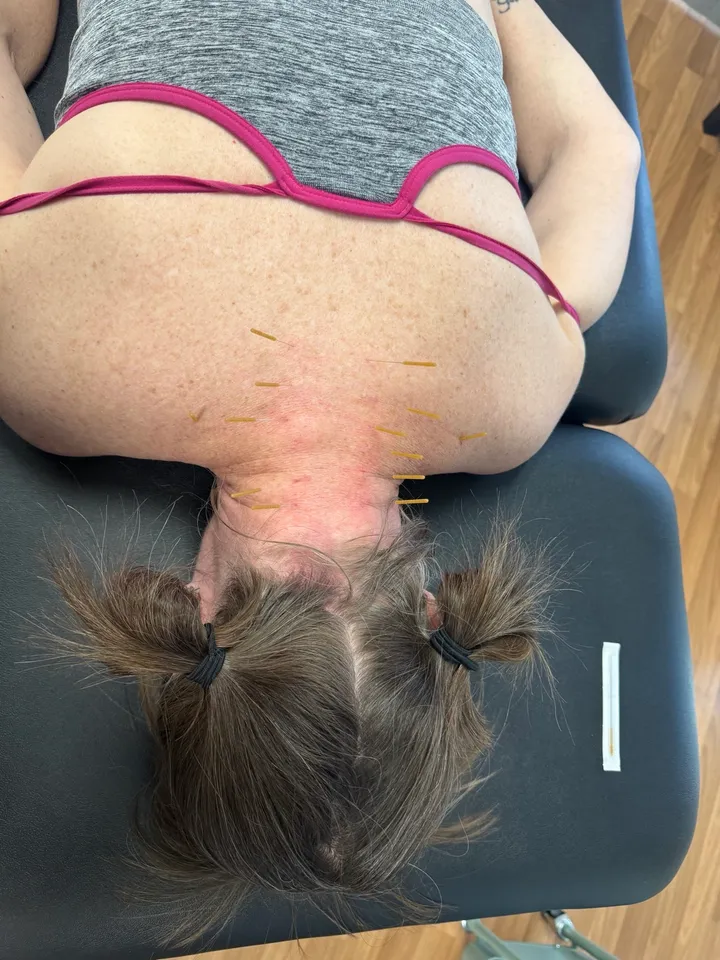 Dry Needling at Healing Hands Physical Therapy in Reno
